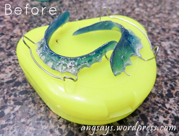 buildup on retainers Cleaning retainers